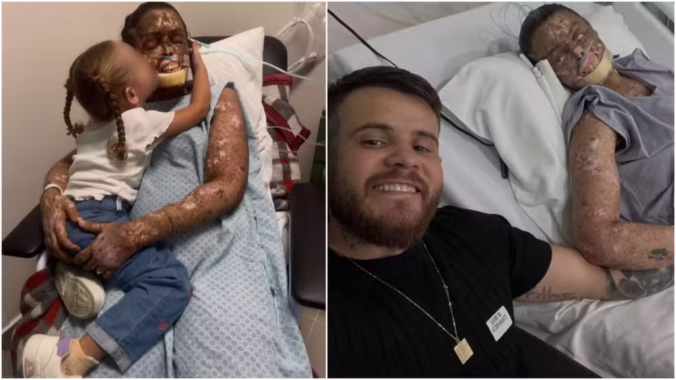  O que é xeroderma pigmentoso, doença genética rara que aumenta o risco de câncer de pele